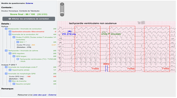 quiz ecg uness cardiologie réponse